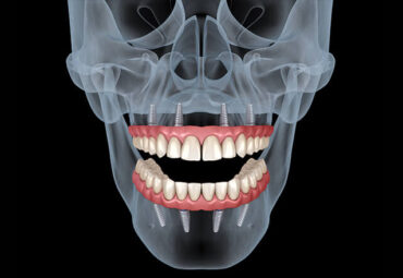 Dental implanter skull images with teeth