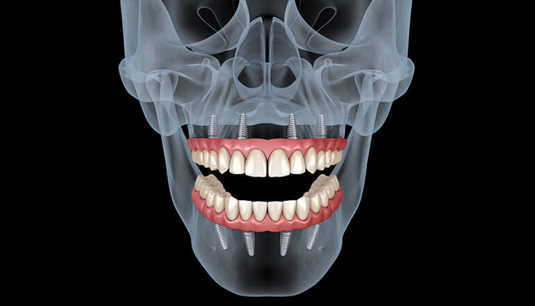 Dental implanter skull images with teeth