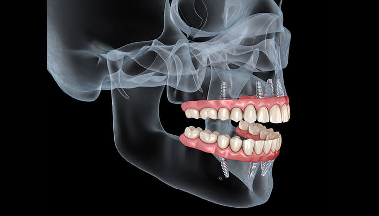 Top Dental Clinics in Mumbai offering advanced dental implant treatment