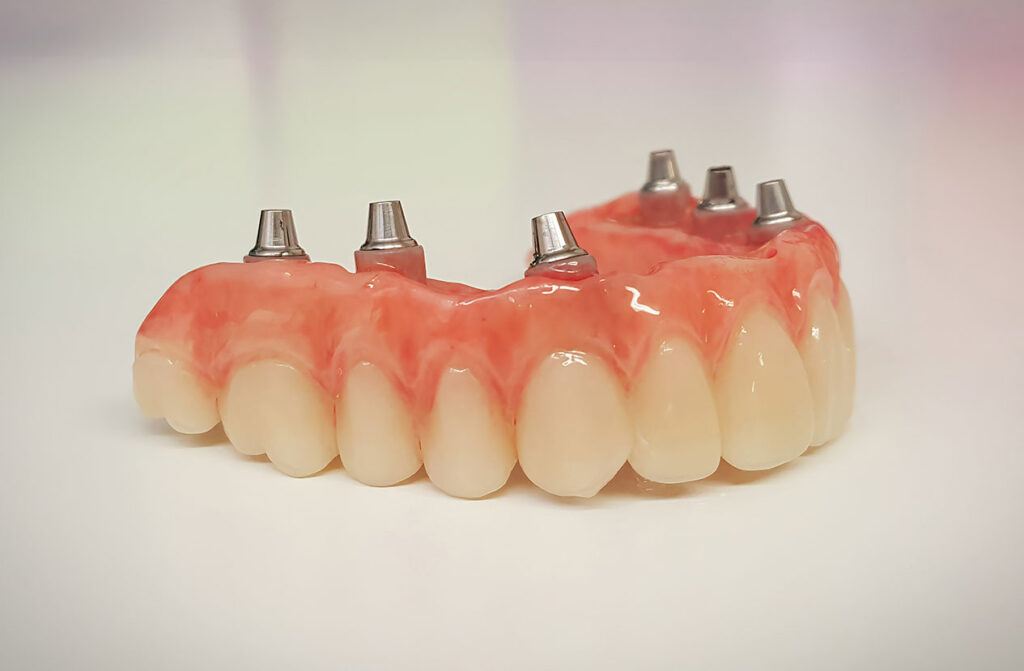 multiple dental implants
