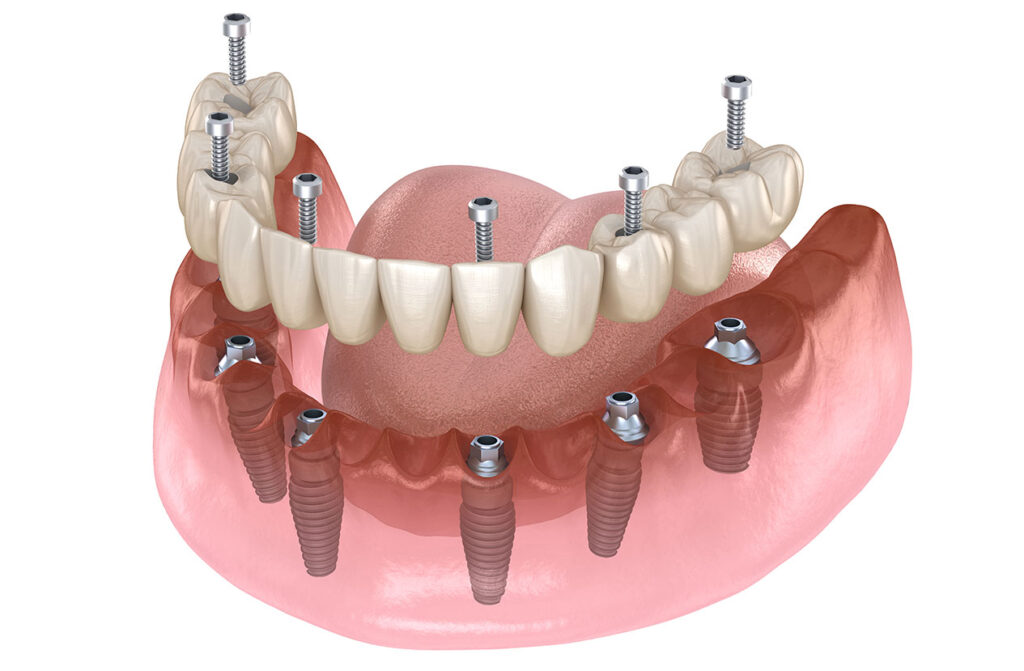 Dental implants in Mumbai 1 year results screw retained implant case