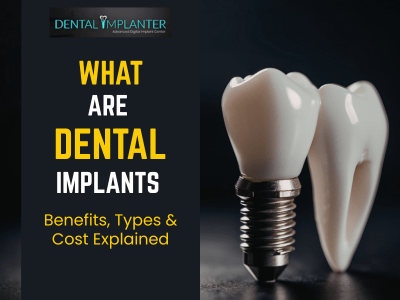 Illustration of a dental implant with a crown next to a natural tooth, with text “What Are Dental Implants – Benefits, Types & Cost Explained” on a dark background.