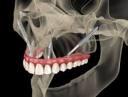 zygmotic implants
