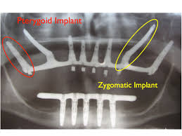 Pterygoid Implants & Zygomatic Implants