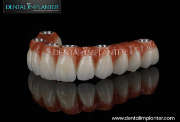 The image features a high-quality full-arch dental implant prosthesis, also known as an "All-on-X" fixed bridge. It showcases a complete set of prosthetic teeth attached to a pink, gingival-colored base designed to mimic natural gum tissue. The top of the bridge reveals several precision-engineered metal connection points where the structure would be securely bolted onto dental implants surgically placed in the jawbone. This dental restoration is displayed against a reflective black background, highlighting its realistic aesthetics and professional craftsmanship.